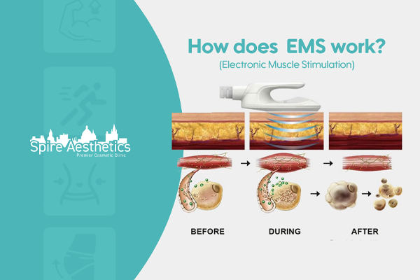 EMS treatment for post pregnancy weight loss treatment Burton upon Trent