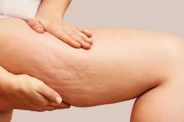 Image of woman showing leg with cellulite Burton upon Trent