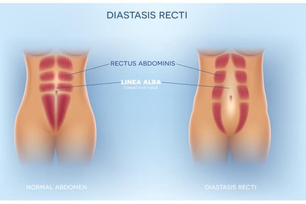 What Non-Surgical Options Are Available for Diastasis Recti Burton upon Trent?