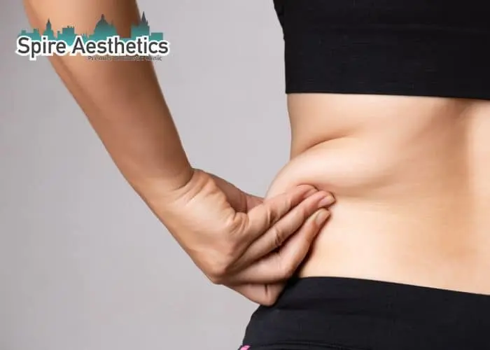 Image of woman pinching fat on their hips Burton upon Trent. Fat Freezing treatment