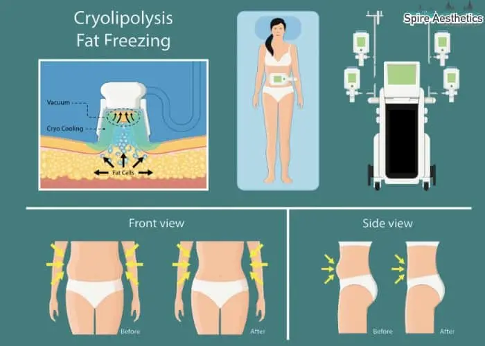 Fat freezing treatment Burton upon Trent benefits for competitions to remove stubborn fat deposits.