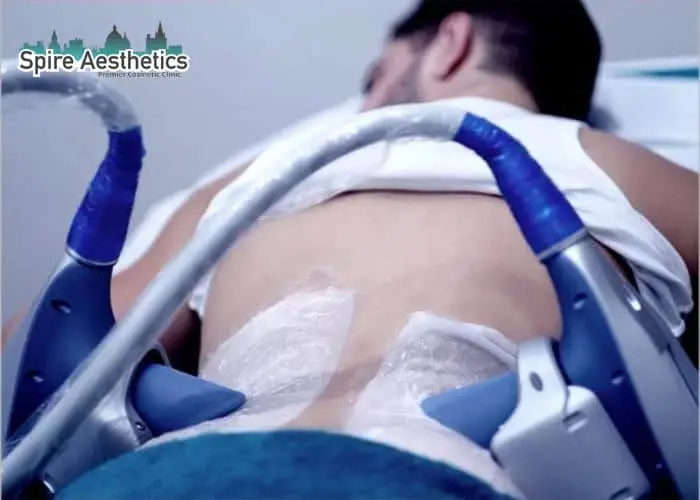 Man having fat freezing treatment done on love handles before a competitions Burton upon Trent to create a sculpted look.