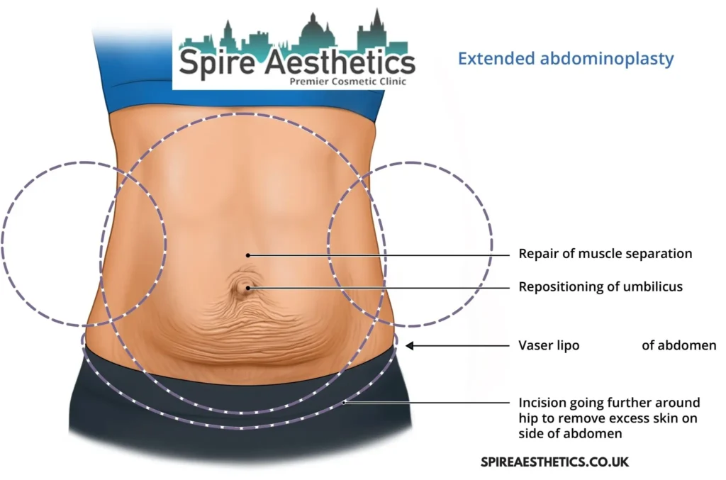 Understanding Loose Skin After Gastric Band Burton upon Trent Surgery and HIFU Treatment