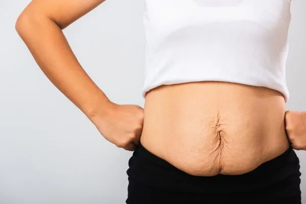 Image of a woman's stomach after weight loss with sagging skin following a gastric band Burton upon Trent