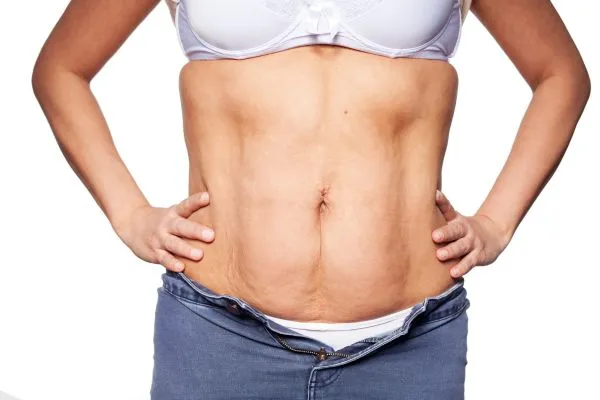 sagging skin on woman's stomach after weight loss injections Burton upon Trent