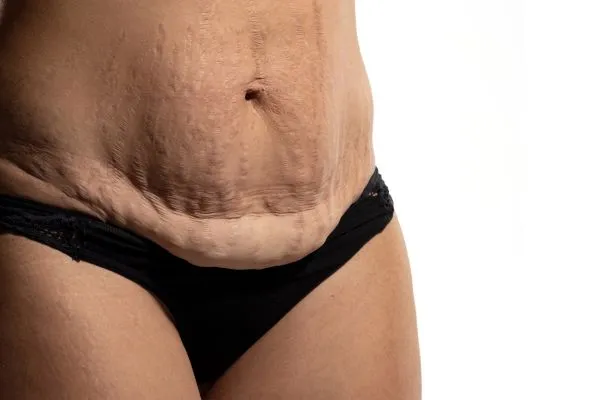 Image of womans stomach after weight loss injections Burton upon Trent showing saggy skin