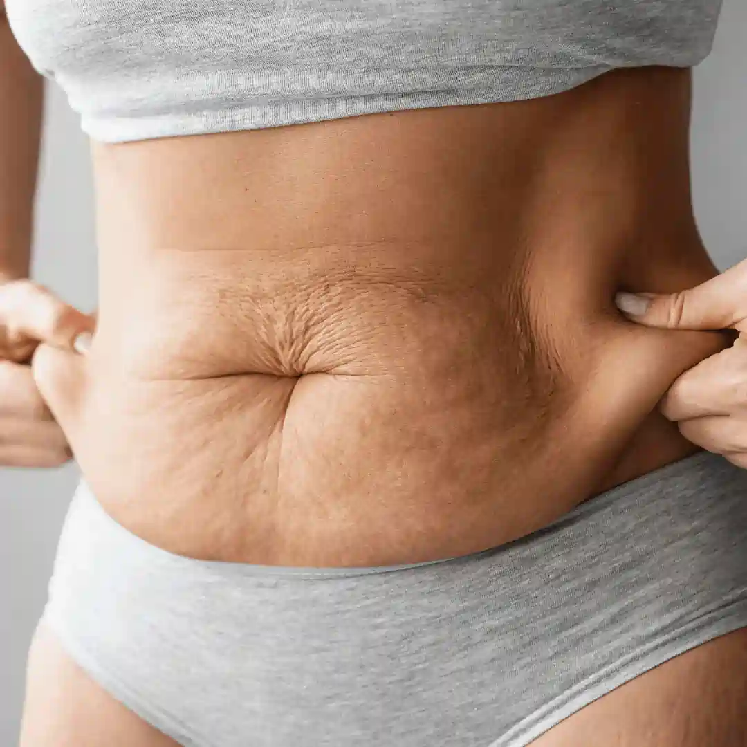 Is It Normal to Have Loose Skin After Pregnancy Burton upon Trent?