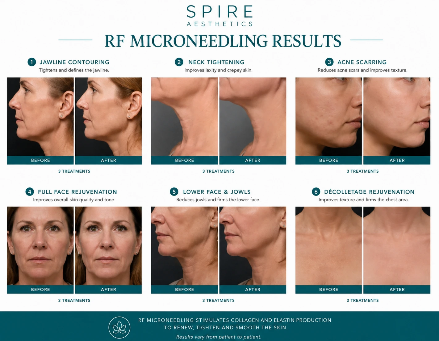 RF Microneedling Skin tightening Burton upon Trent results