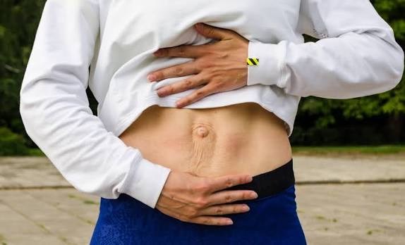 When Could Diastasis Recti Be the Missing Piece of the Puzzle Burton upon Trent?