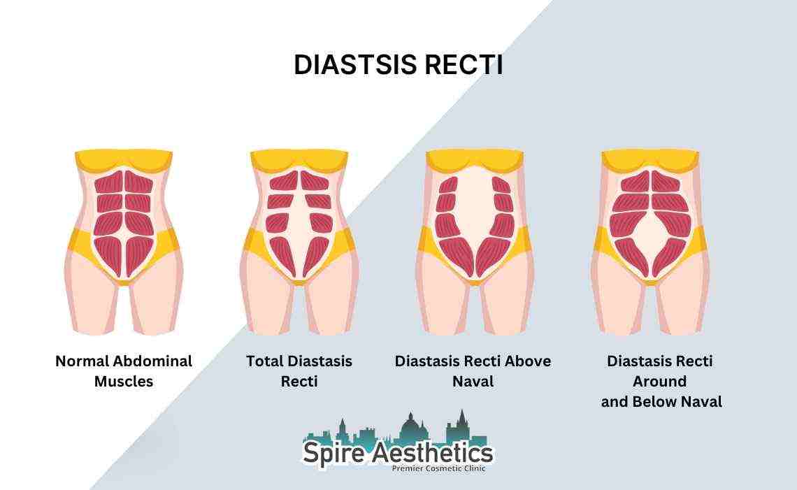 Is Non-Surgical Diastasis Recti Treatment Right for You? Common Concerns Answered Burton upon Trent